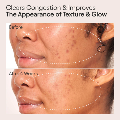 ALPYN Retinol Clarifying Oil for Congestion & Wrinkles