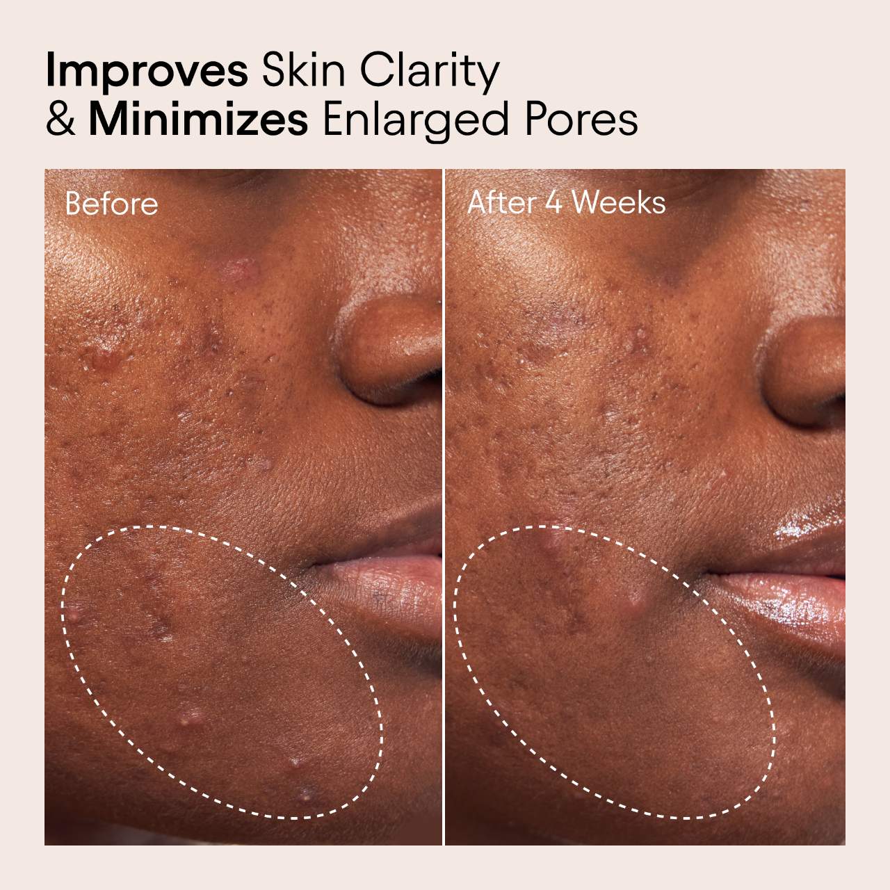 ALPYN 2% BHA Pore Perfecting Liquid Exfoliator for Brighter & Clearer Skin