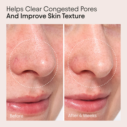 ALPYN Retinol Clarifying Oil for Congestion & Wrinkles