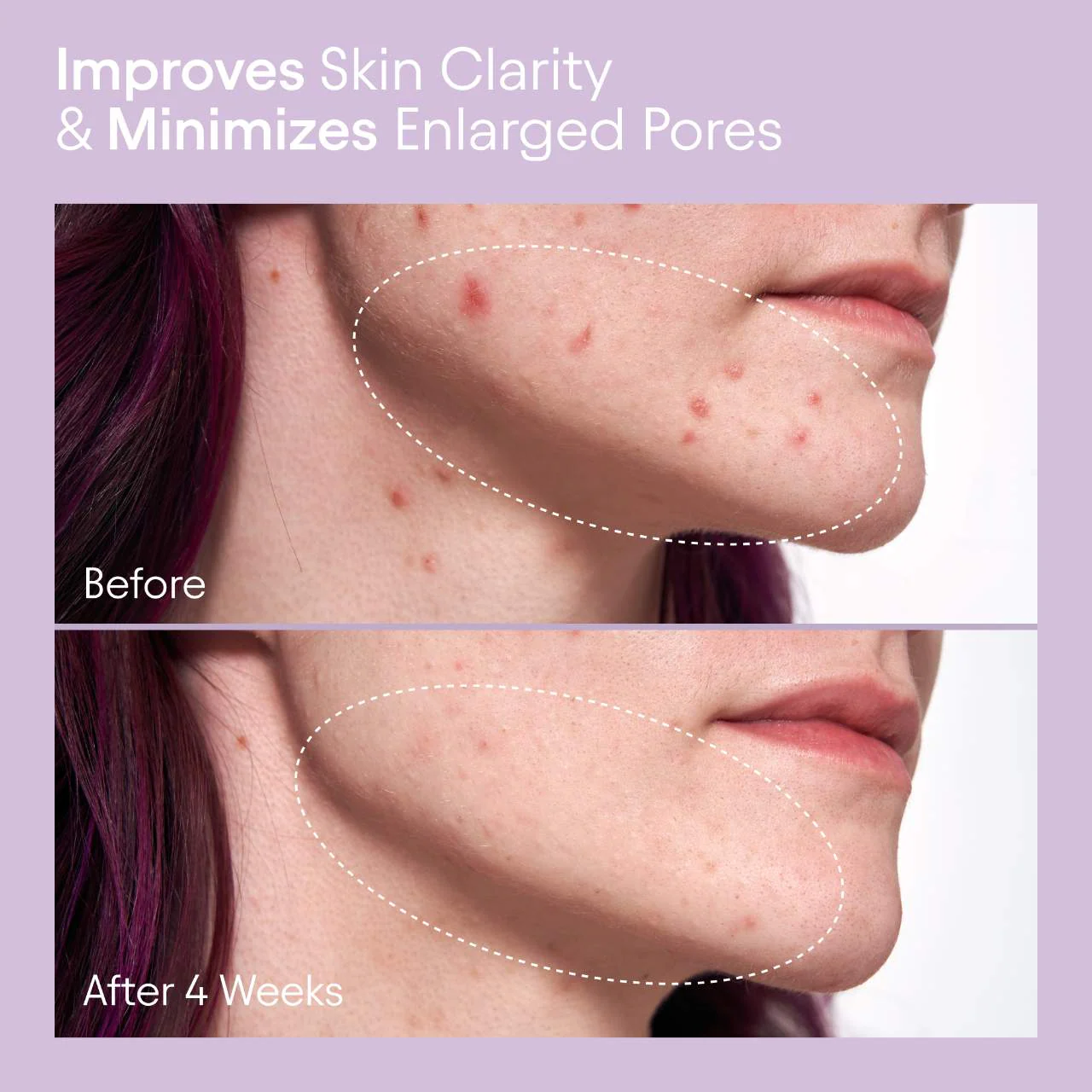 ALPYN 2% BHA Pore Perfecting Liquid Exfoliator for Brighter & Clearer Skin